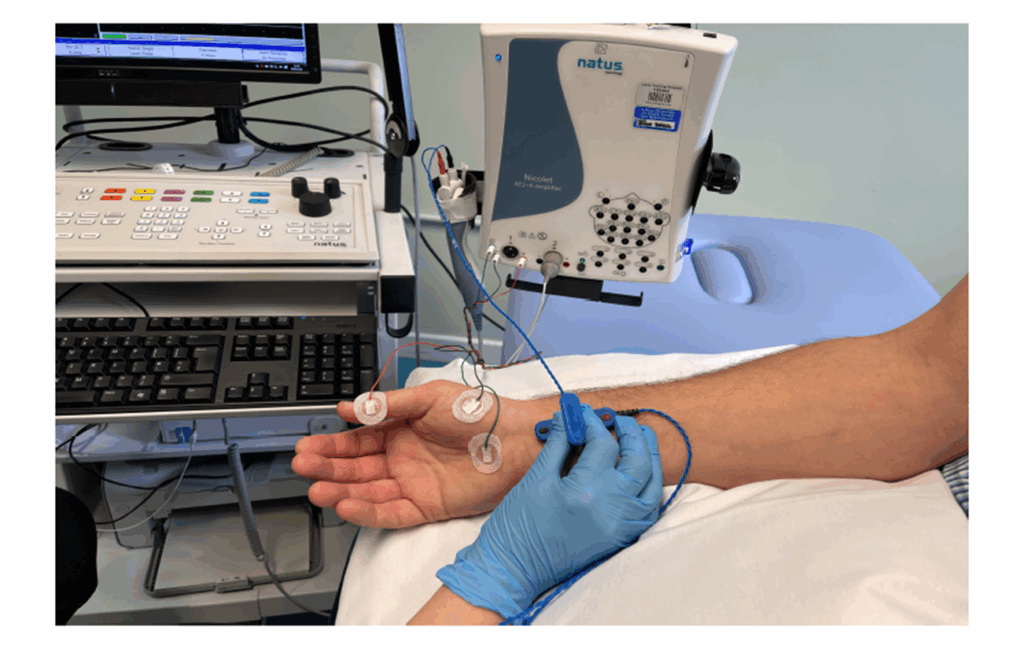 Photograph of a person having electrical pulses through the hand