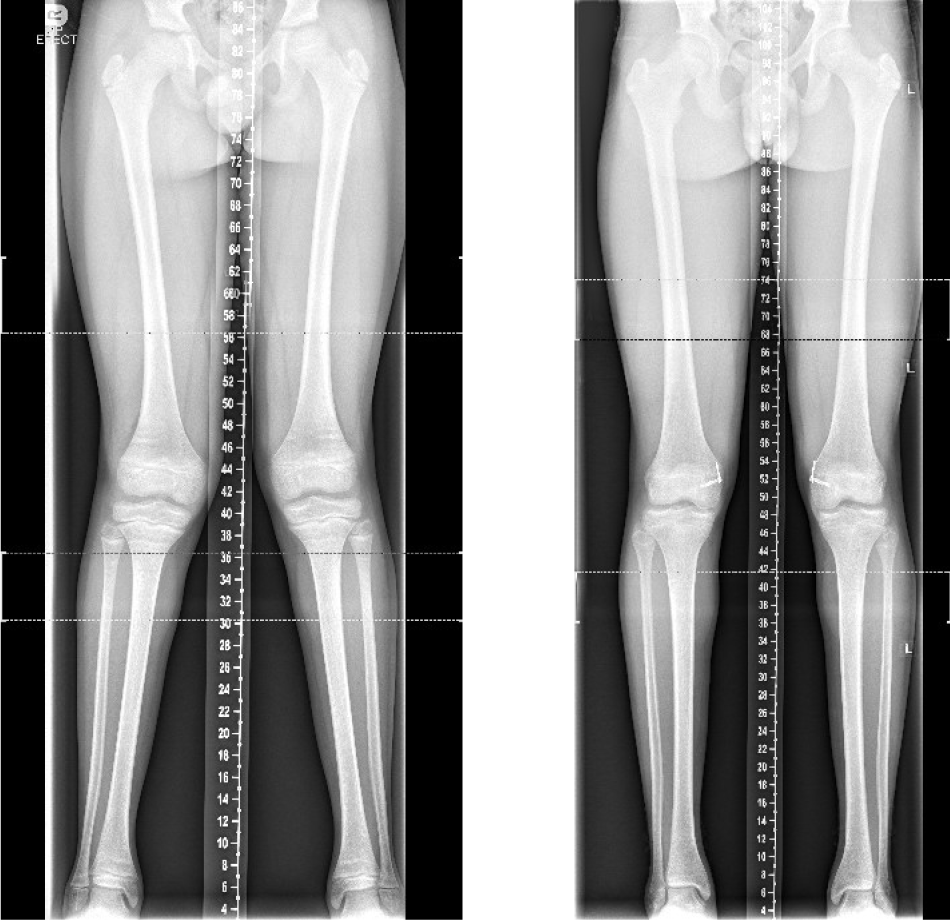 X-ray images showing how the Epiphysiodesis surgical procedure is used on growing children and adolescents.