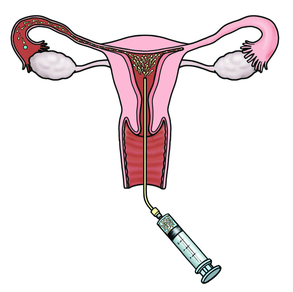 Illustration showing the womb cervix and vagina with the insemination catheter in place and sperm being injected into the womb cavity.
