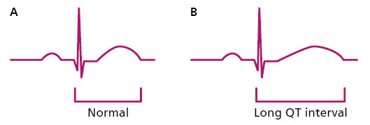 Graph A showing a normal QT interval. Graph B showing a Long QT interval