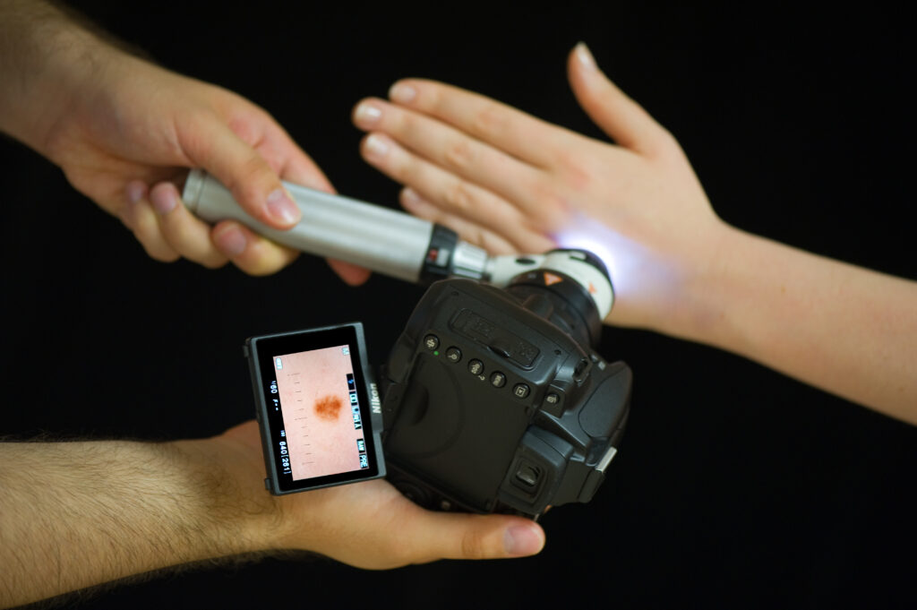 Photograph of a dermatoscope camera photographing a mole on a hand