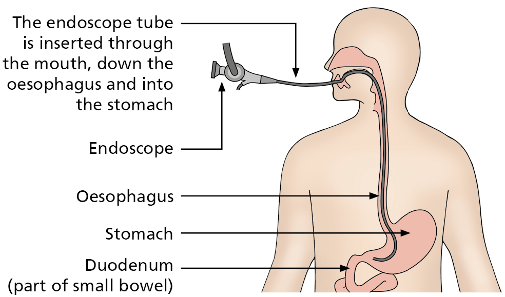 Anatomical illustration showing the endoscope tube inserted through the mouth, down the oesophagus and into the stomach. The endoscope, oesophagus, stomach and duodenum (part of small bowel) are all labled.