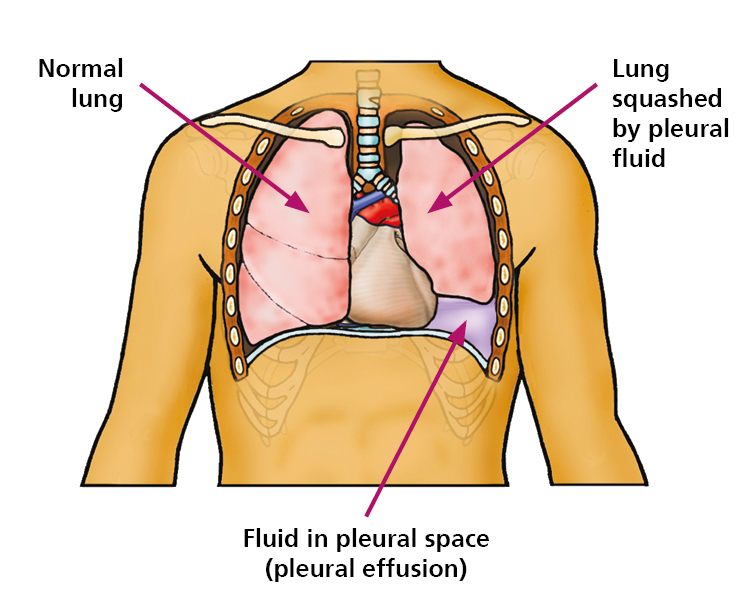 Anatomical illustration of the lungs showing a normal lung on the left and a lung squashed by pleural fluid on the right which has fluid in the pleural space (pleural effusion).