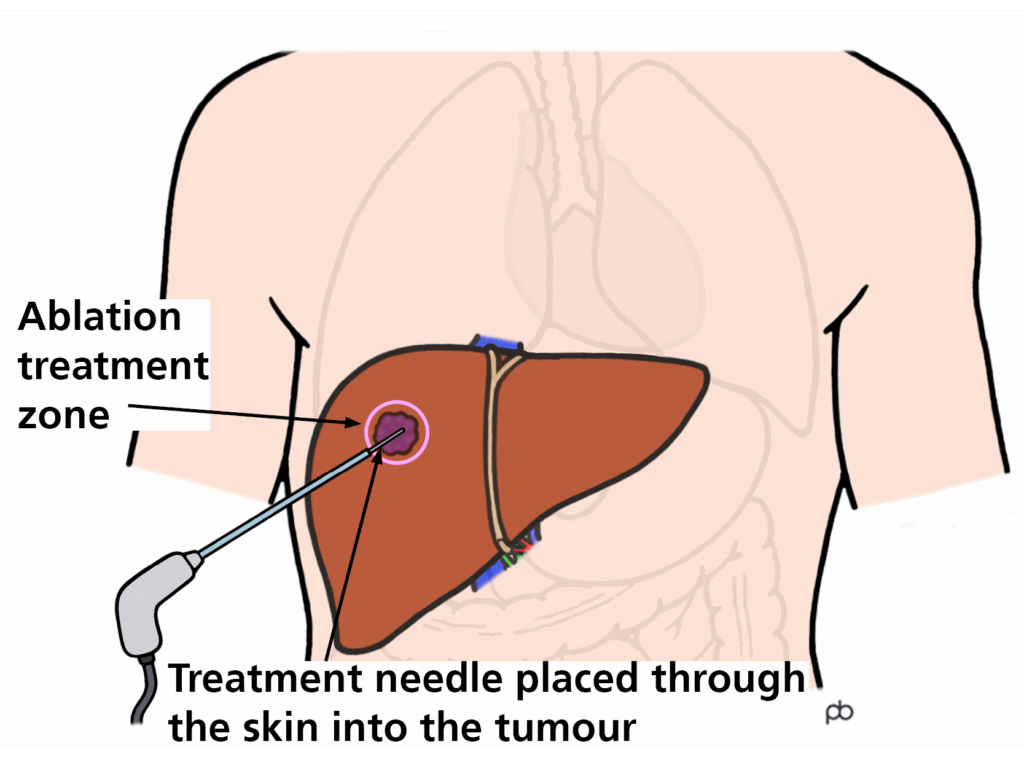 The picture shows the needle being inserted into the liver tumour 