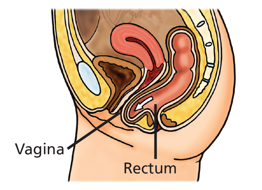 Illustration showing Back (Posterior) vaginal wall prolapse.