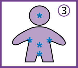 An illustration showing the attention starred areas on a persons body.