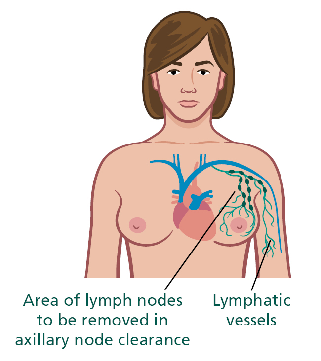 Illustration of the body showing the area of lymph nodes to be removed in axillary node clearance. The Lymphatic vessels are labelled.
