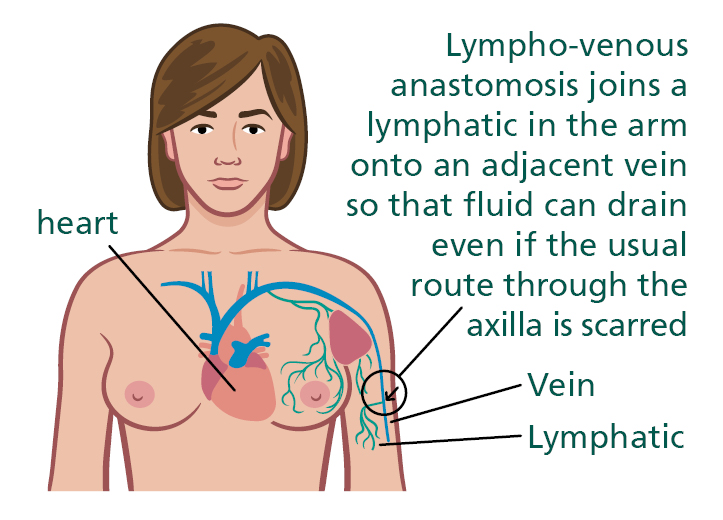 Illustration of the body showing lympho-venous anastomosis. The heart, vein and lymphatic are labelled. Text says Lympho-venous anastomosis joins a lymphatic in the arm onto an adjacent vein so that fluid can drain even if the usual 
route through the axilla is scarred.
