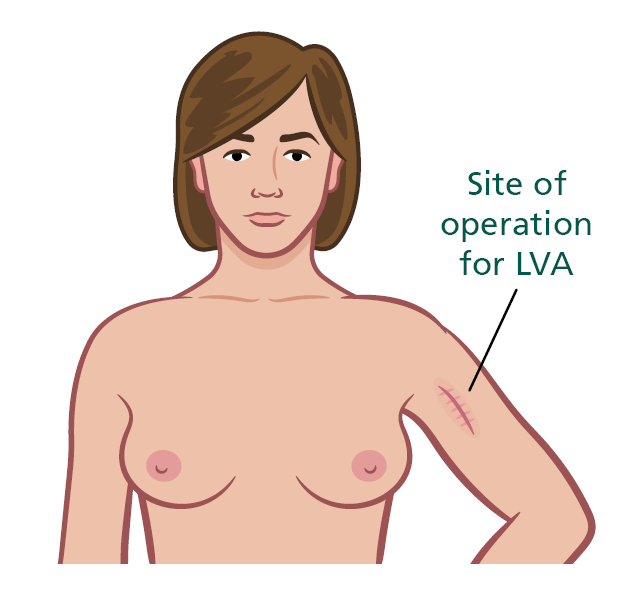 Illustration showing the scar at the site of the operation for LVA.