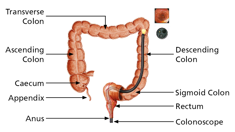 Anatomical illustration of the large intestine, showing the colonoscope going in the anus, up the rectum, around the sigmoid colon and up the descending colon.