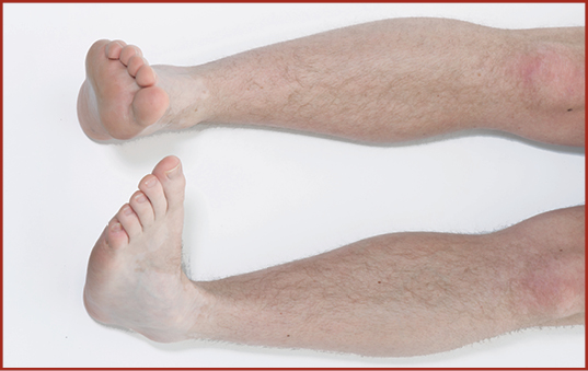 Photograph showing 2 legs laid flat looking down. The toes on both feet are being pointed inwards towards each other.