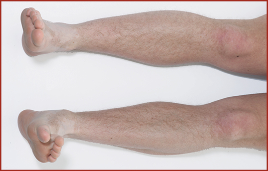 Photograph showing 2 legs laid flat looking down. The toes on both feet are being pointed outwards away from each other.