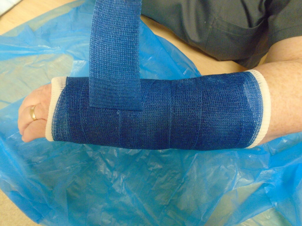 Photograph of a person peeling the bandage from a cast on their arm