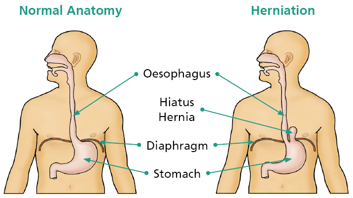 Illustration showing the stomach with no Hiatus Hernia and showing the stomach with a Hiatus Hernia with labels.