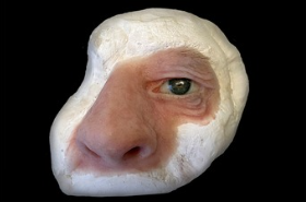 Facial prosthesis