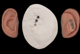 Implant-retained auricular prosthesis