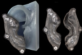 Keloid splint