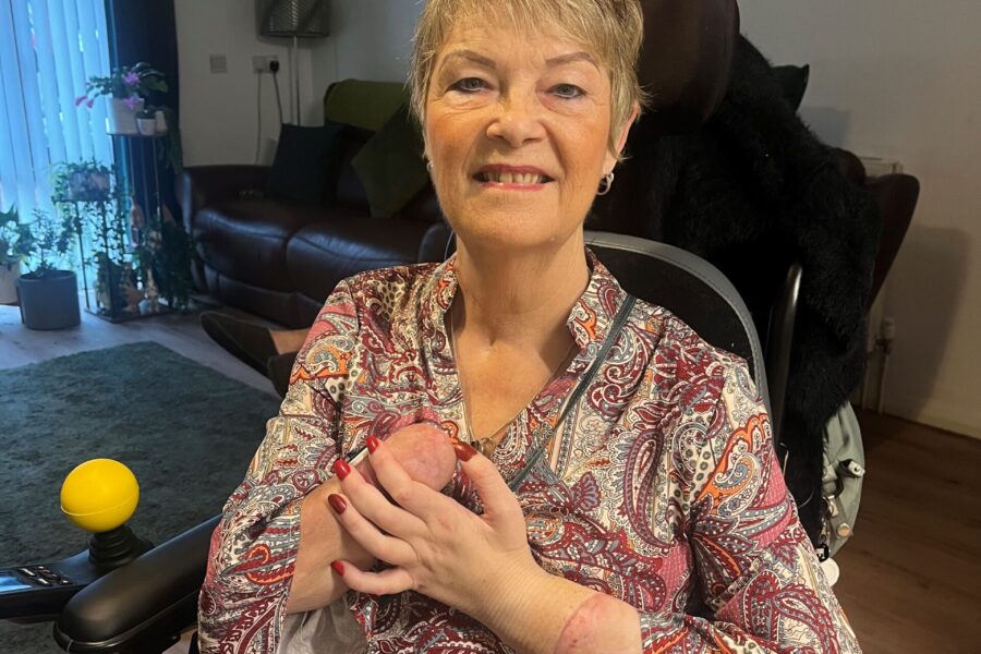 A woman amputee with a transplanted hand.
